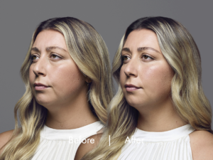 model lexi ba photo 01 Suria Cosmetic Surgery & Medspa