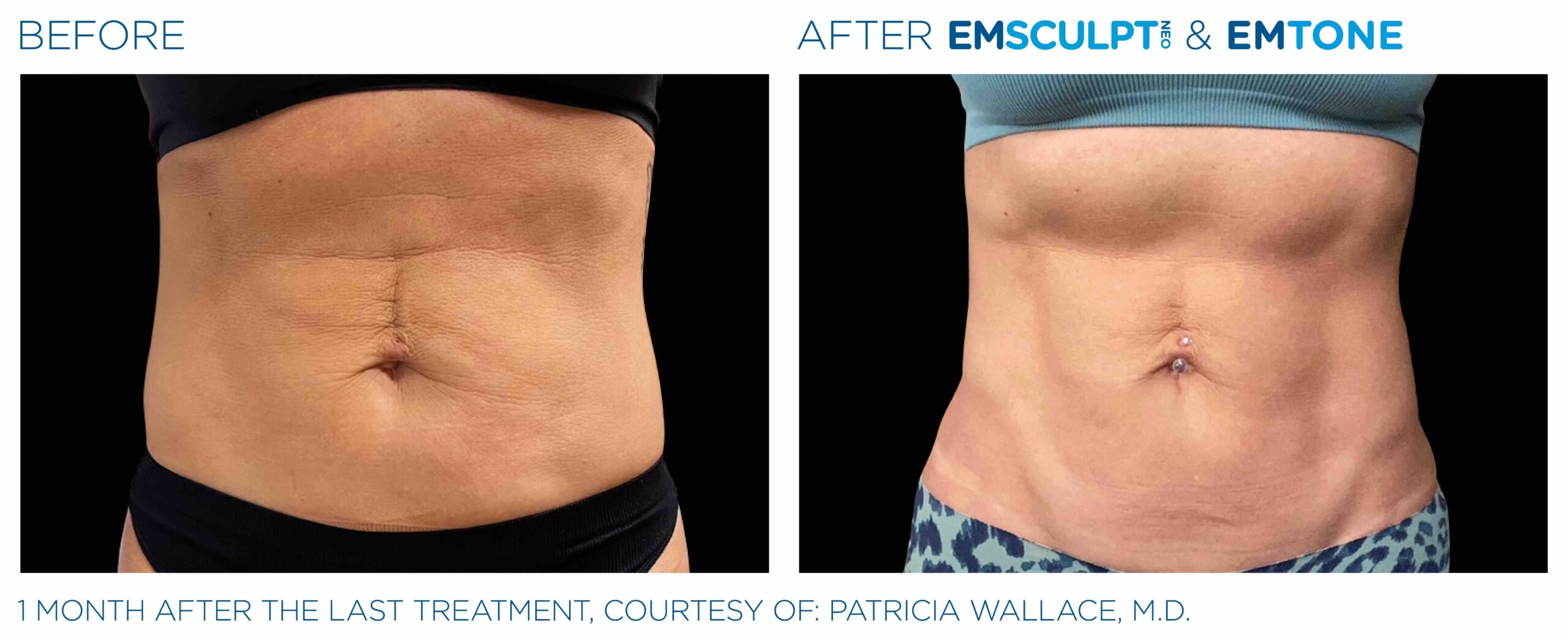 Emsculpt_Neo-Emtone_PIC_Ba-card-female-abdomen-001_ENUS100-scaled-1.jpeg