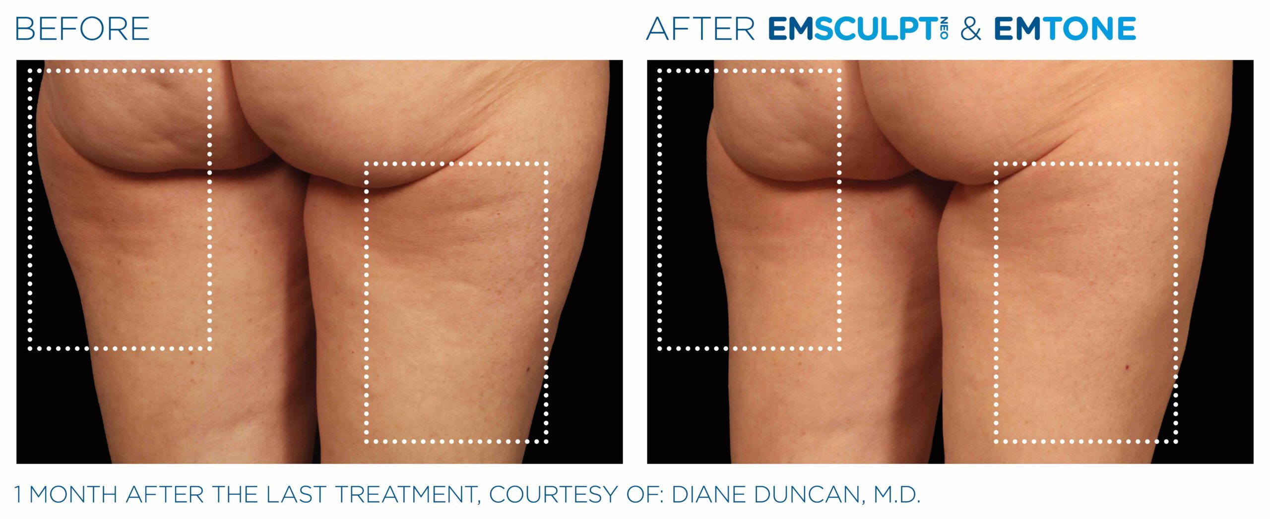 Emsculpt_Neo-Emtone_PIC_Ba-card-female-back-thigh-002_ENUS100-scaled-1.jpeg