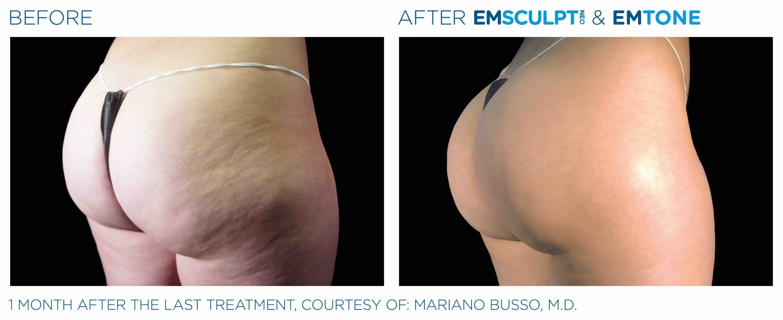 Emsculpt_Neo-Emtone_PIC_Ba-card-female-buttock-008_ENUS100-scaled-1.jpeg