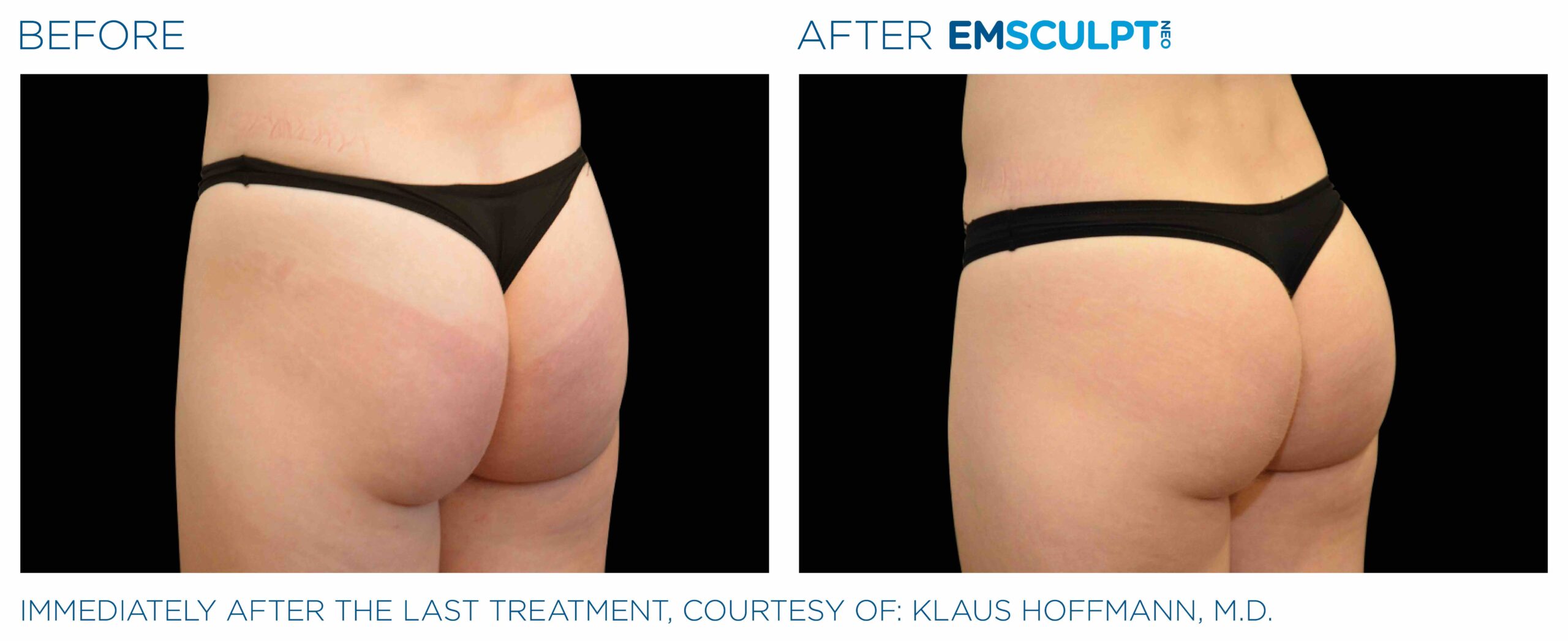 Emsculpt_Neo_PIC_Ba-card-female-buttock-045_ENUS100-scaled-1.jpeg