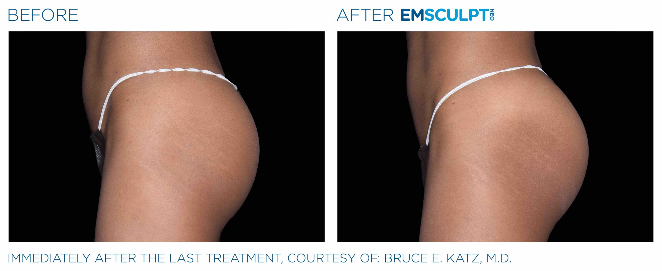 Emsculpt_Neo_PIC_Ba-card-female-buttock-087_ENUS100-scaled-1.jpeg