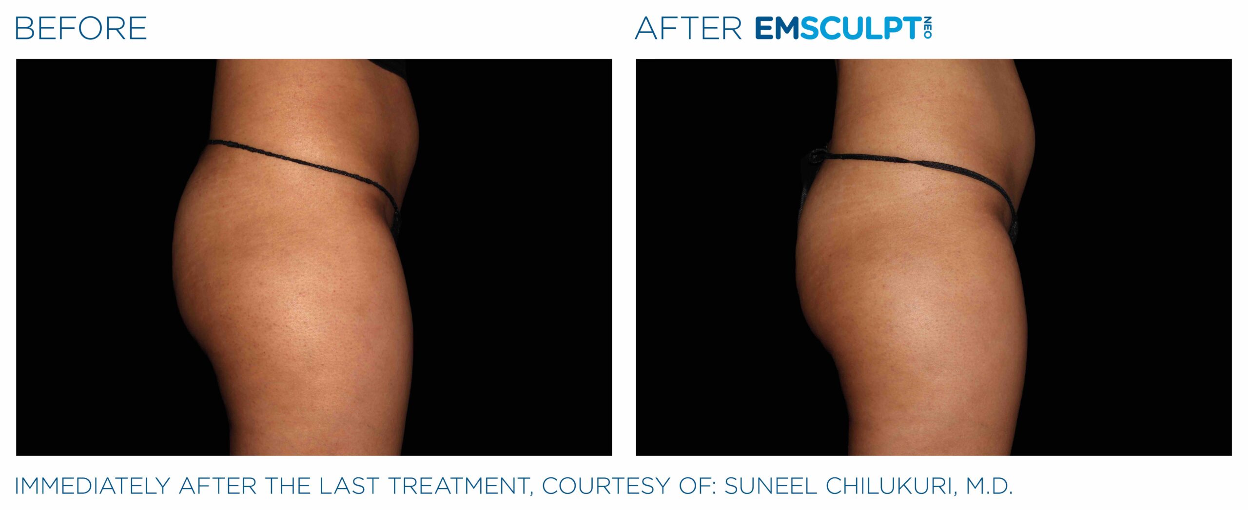 Emsculpt_Neo_PIC_Ba-card-female-buttock-089_ENUS100-scaled-1.jpeg