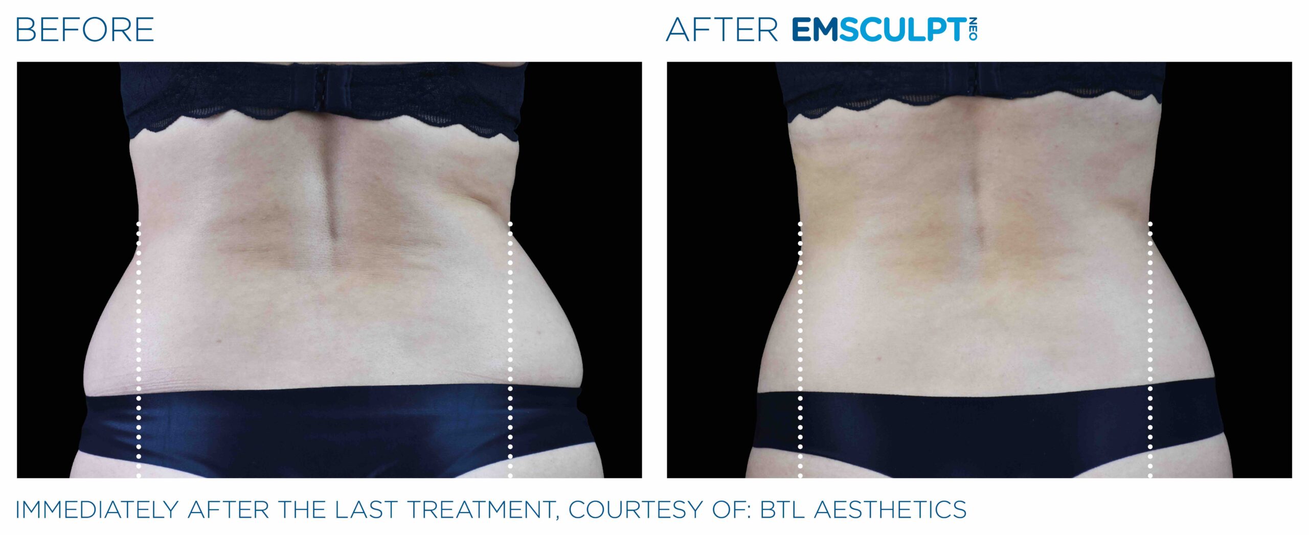 Emsculpt_Neo_PIC_Ba-card-female-lateral-abdomen-101_ENUS100-scaled-1.jpeg