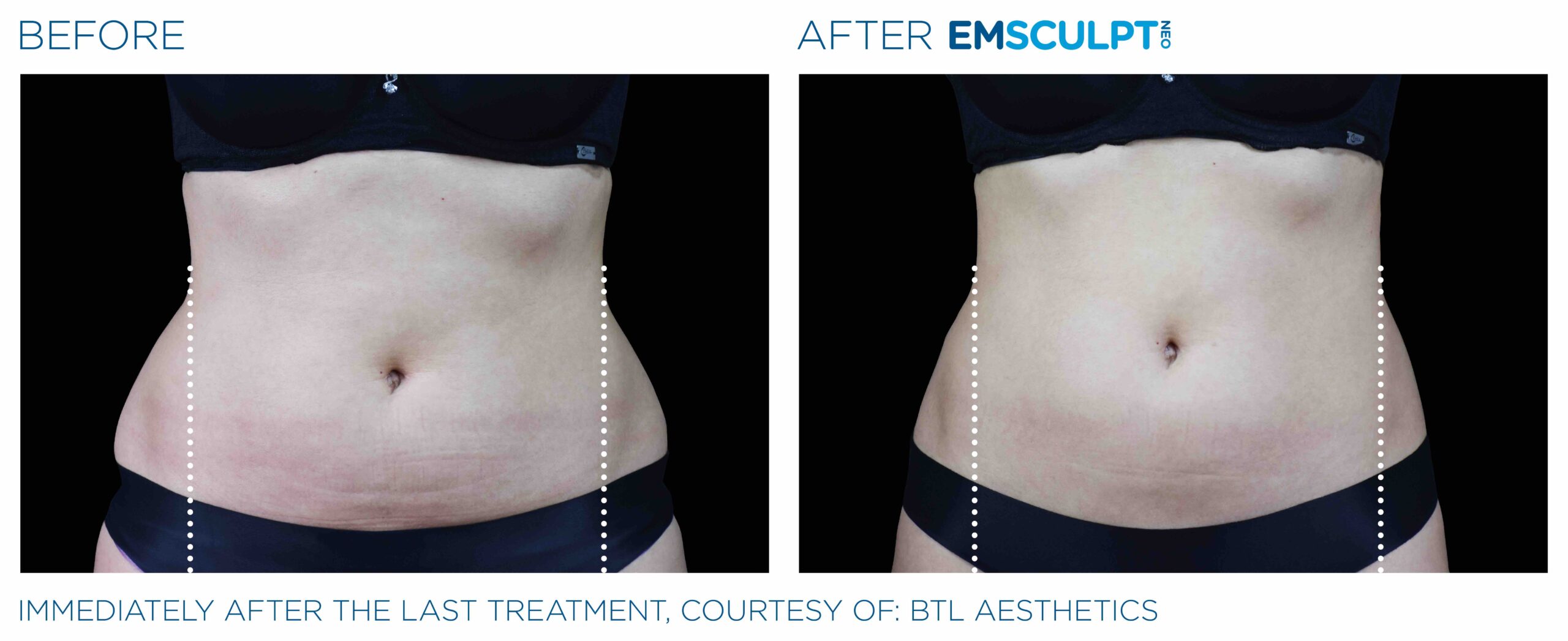 Emsculpt_Neo_PIC_Ba-card-female-lateral-abdomen-102_ENUS100-scaled-1.jpeg