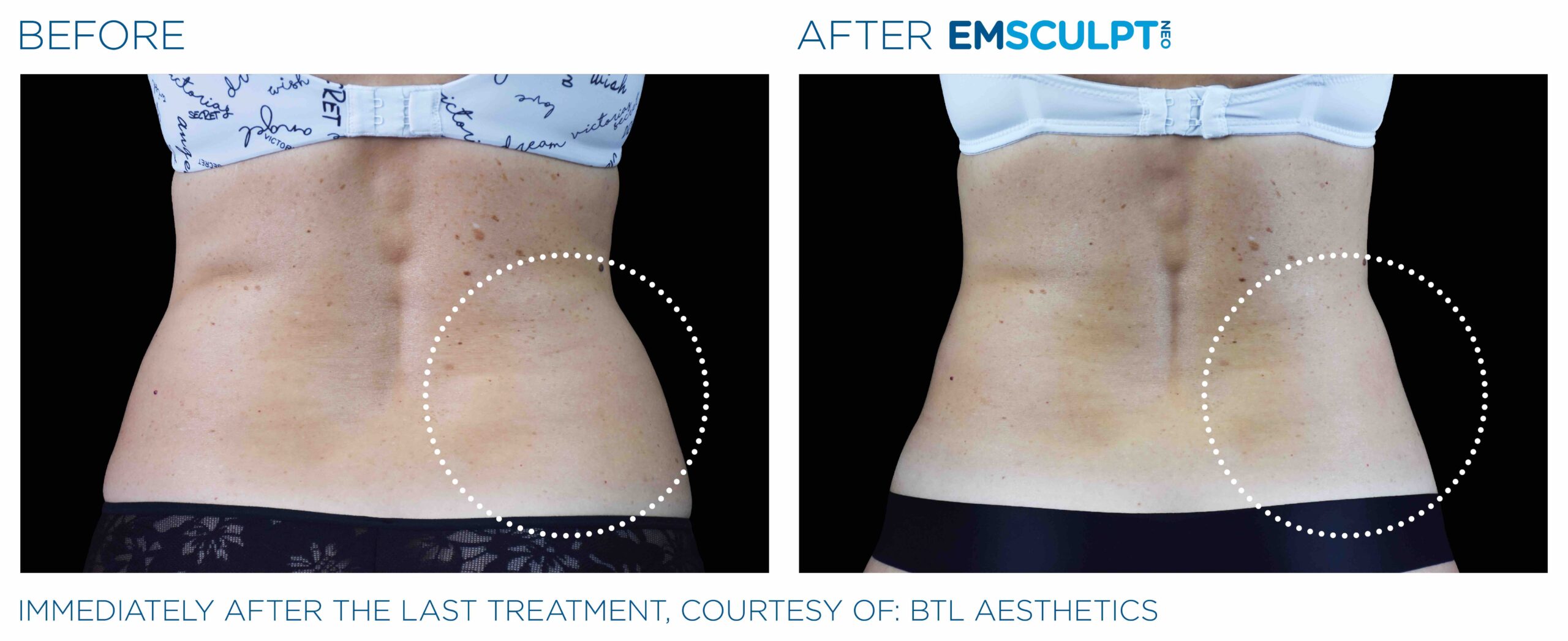 Emsculpt_Neo_PIC_Ba-card-female-lateral-abdomen-103_ENUS100-scaled-1.jpeg