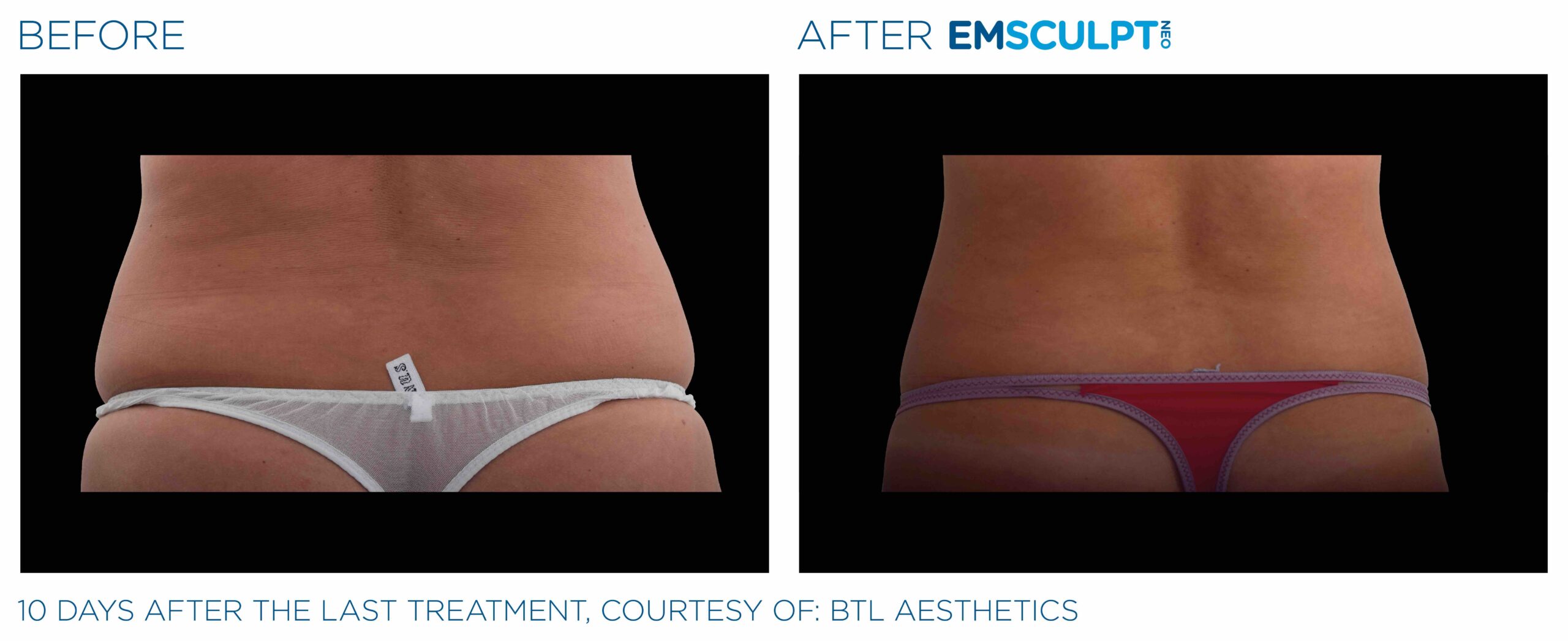 Emsculpt_Neo_PIC_Ba-card-female-lateral-abdomen-104_ENUS100-scaled-1.jpeg