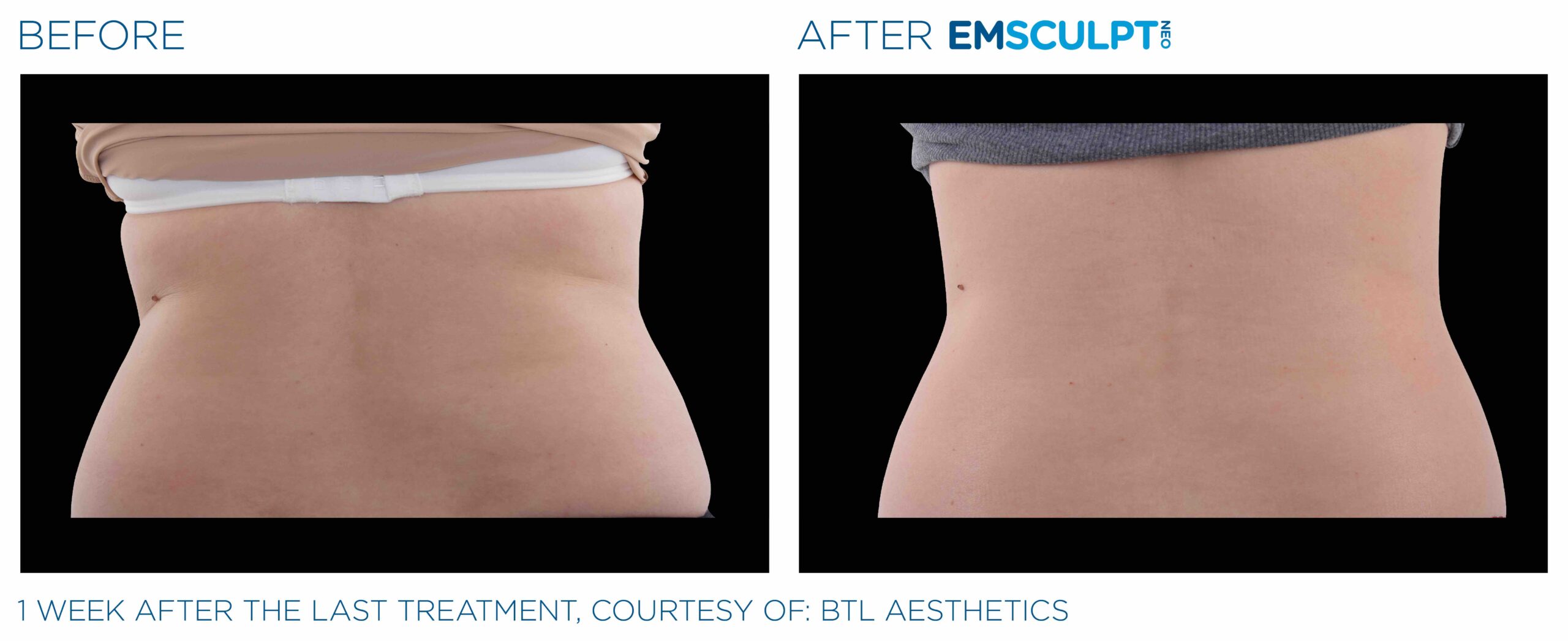 Emsculpt_Neo_PIC_Ba-card-female-lateral-abdomen-112_ENUS100-scaled-1.jpeg