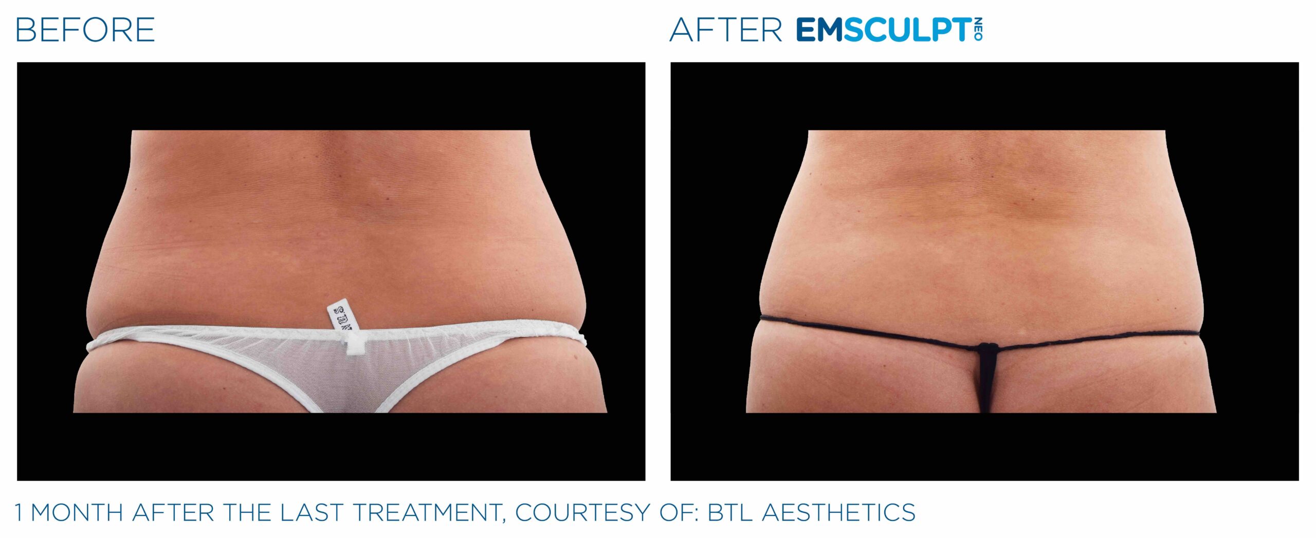 Emsculpt_Neo_PIC_Ba-card-female-lateral-abdomen-113_ENUS100-scaled-1.jpeg