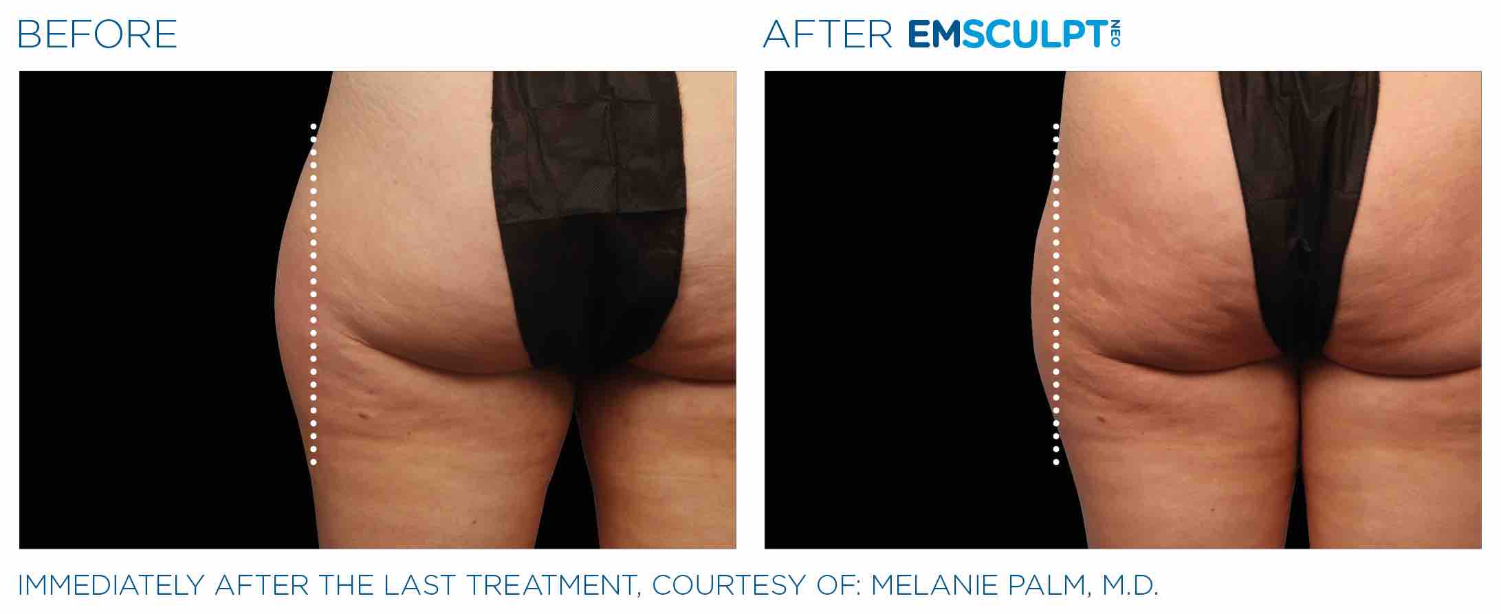 Emsculpt_neo_PIC_Ba-card-female-outer_thighs-053_ENUS100.jpeg