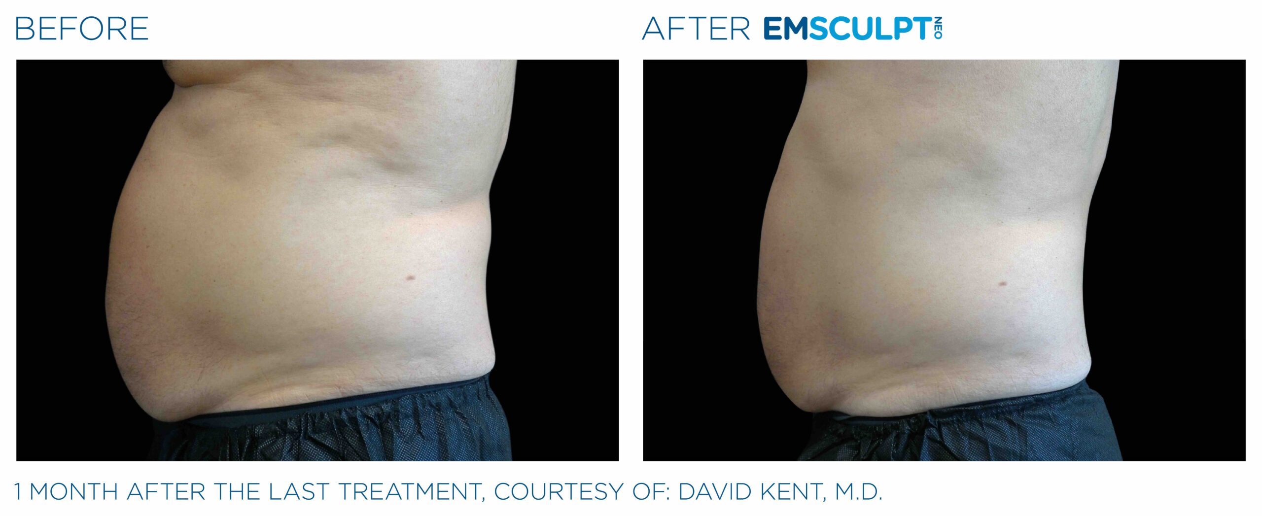 Emsculpt_neo_PIC_Ba-card-male-abdomen-002_ENUS100-scaled-1.jpeg