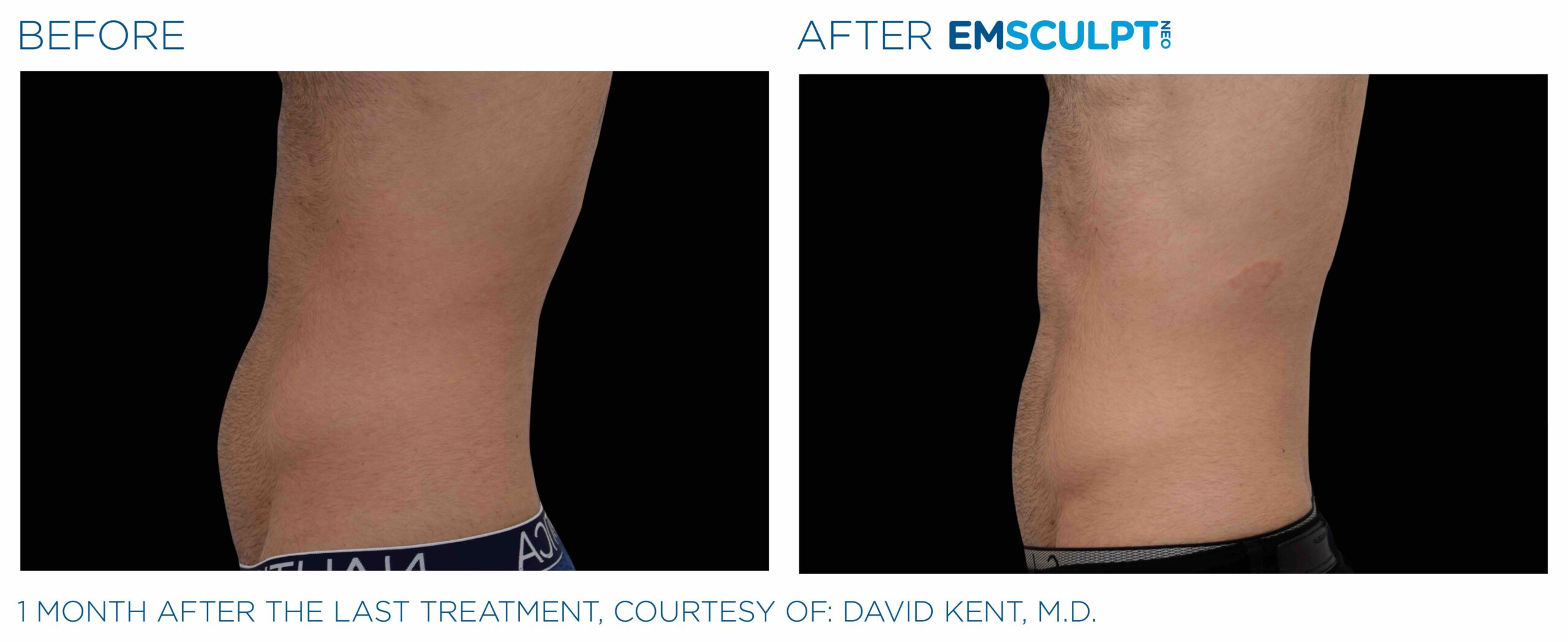 Emsculpt_neo_PIC_Ba-card-male-abdomen-021_ENUS100-scaled-1.jpeg