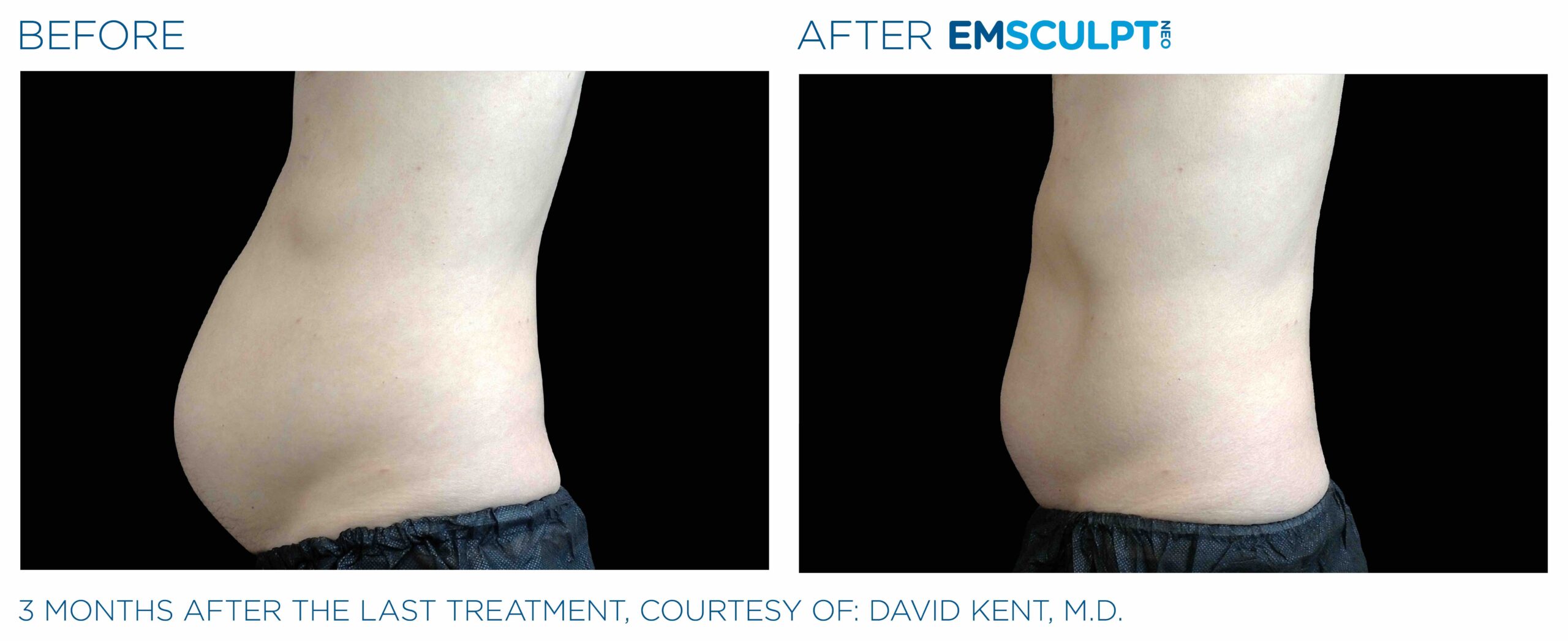 Emsculpt_neo_PIC_Ba-card-male-abdomen-022_ENUS100-scaled-1.jpeg