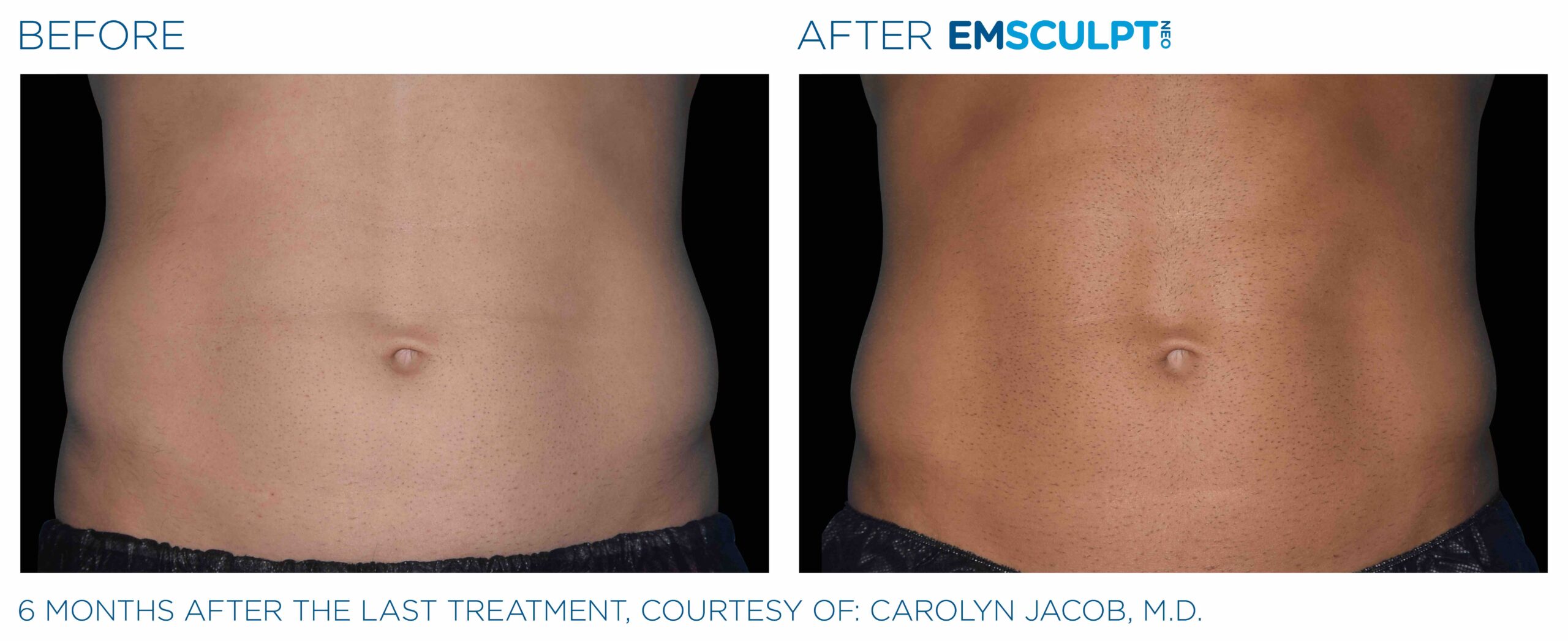 Emsculpt_neo_PIC_Ba-card-male-abdomen-090_ENUS100-scaled-1.jpeg