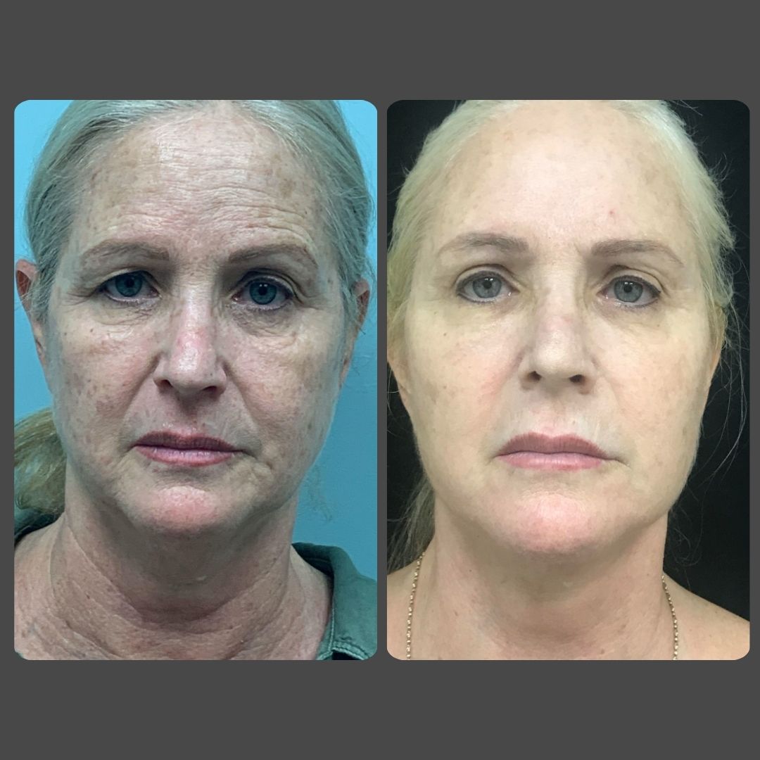 Face Surgery Facelift