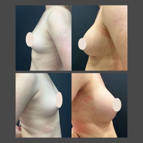 Breast Augmentation