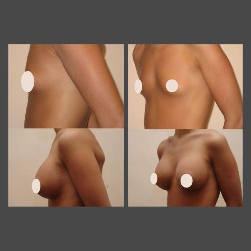 Breast Augmentation