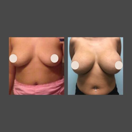 Breast Augmentation