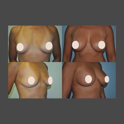 Breast Augmentation