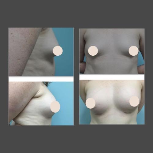 Breast Augmentation