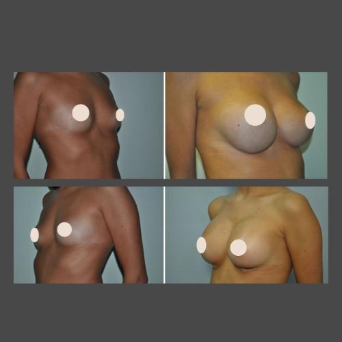 Breast Augmentation