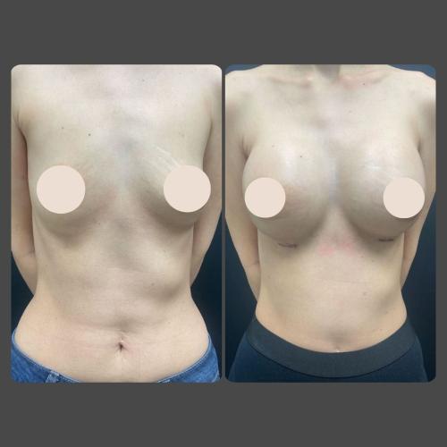 Breast Augmentation