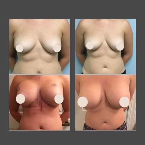 Breast Augmentation