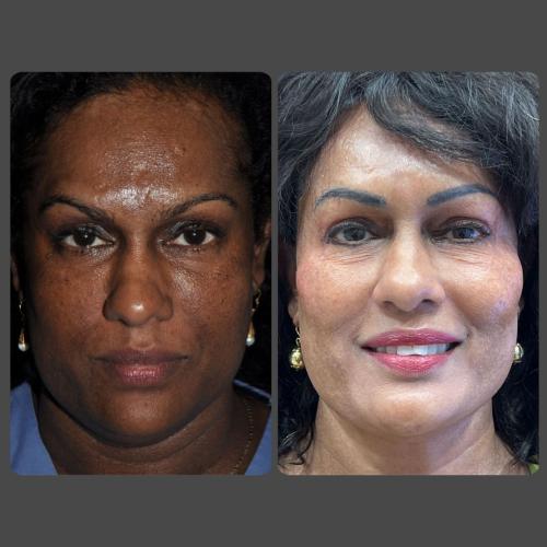 Skin Rejuvenation