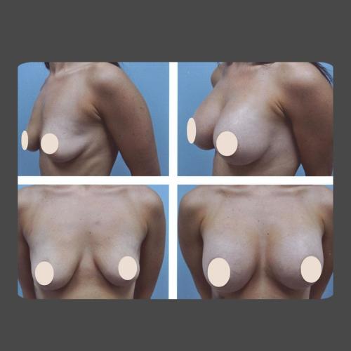 Breast Augmentation