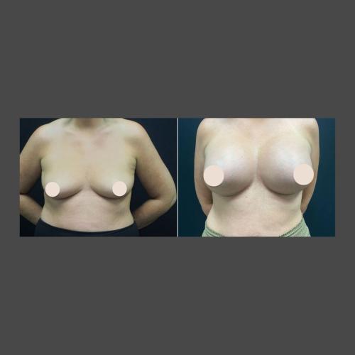 Breast Augmentation