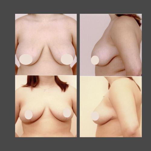 Breast Reduction