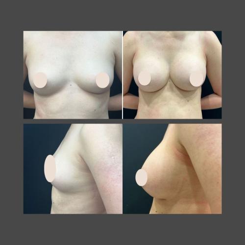 Breast Augmentation