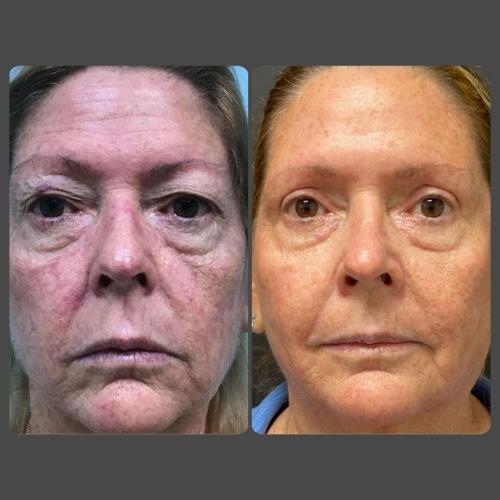 Skin Rejuvenation