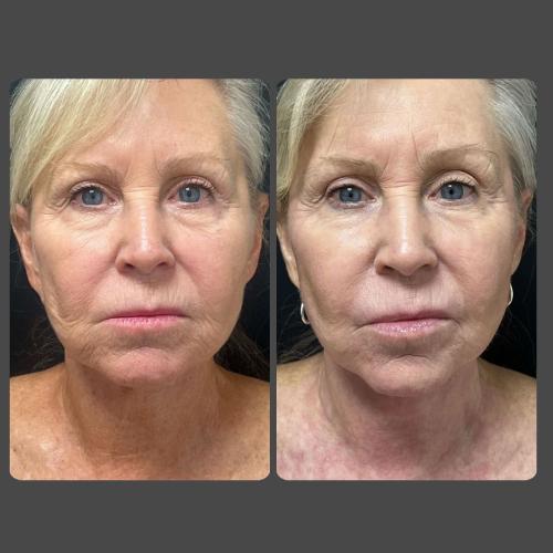 Skin Rejuvenation