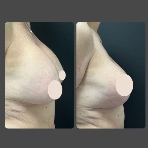 Breast Reduction