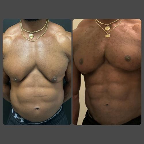 Breast Reduction (Male)