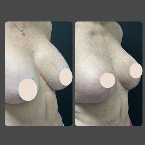 Breast Reduction